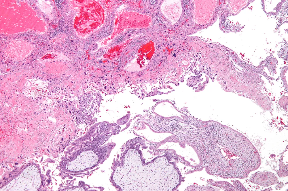 Intermediate_trophoblast_3_-_low_mag Malignant Trophoblastic Disease