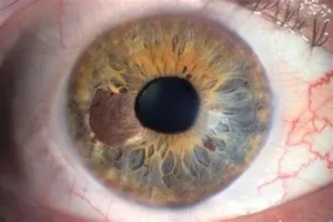 Immunotherapy treatment discovered that can have long-term survival benefit for Uveal melanoma