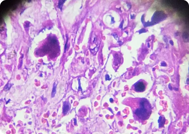 Choriocarcinoma Choriocarcinoma