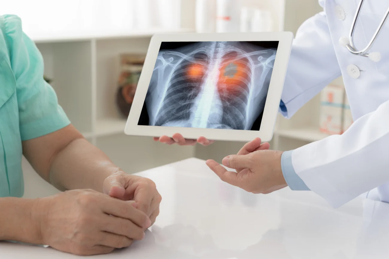Lung Cancer Lung Cancer