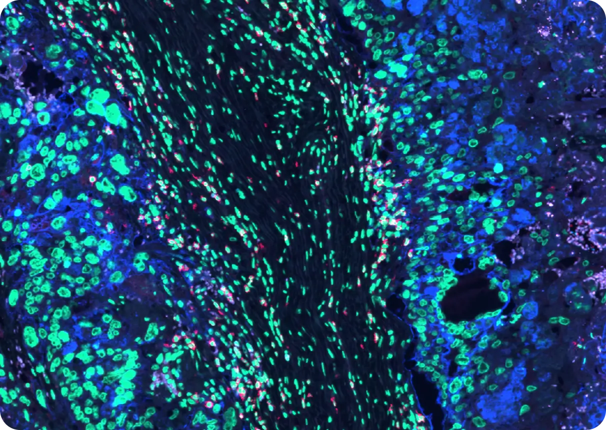 Cancer cells and immune cells interact in GTD